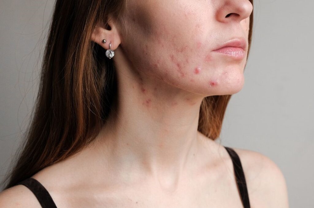 Desvendando a Acne da Mulher Adulta